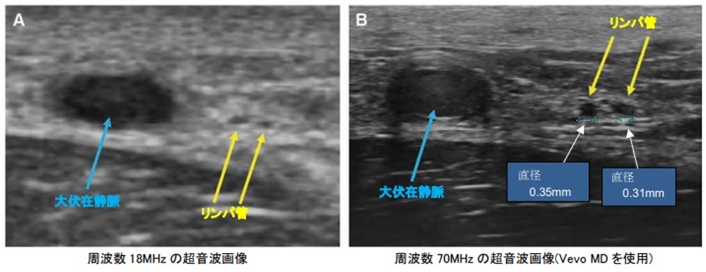 富士フイルムの超音波画像診断装置、0.5mm以下の血管も明瞭に観察